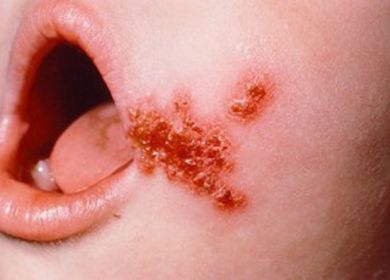 impetigine