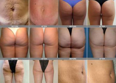 cellulite