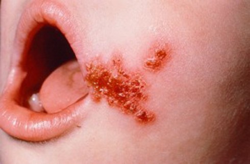 impetigine