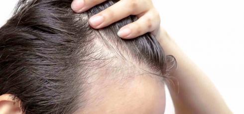 Stati Uniti, la FDA approva la prima pillola per l'alopecia