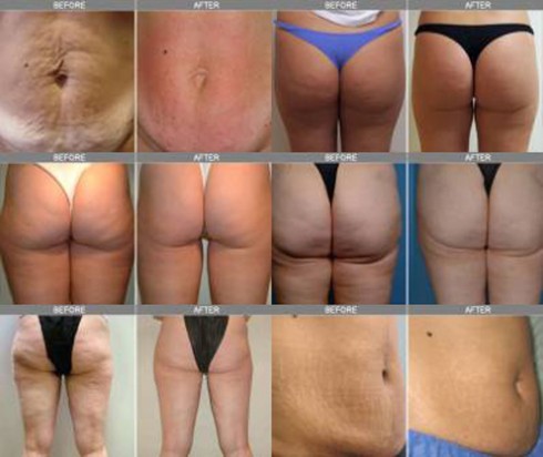 cellulite