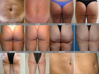 cellulite