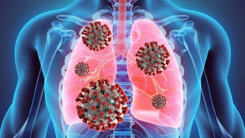 La nuova sindrome da Covid si chiama MIP-C