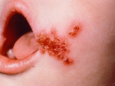 impetigine