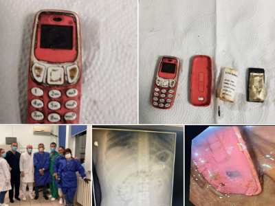 L'origine dei suoi dolori di stomaco era ... un Nokia 3310 – VIDEO- 