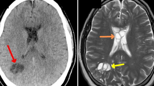 Tenia solium: ingerisce mentre mangia salumi il verme solitario scoperto a causa delle frequenti emicranie